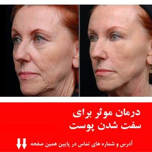 کوکتل مزوتراپی درمان کامل سفت کننده و بازسازی پوست برند درمادو درمافرمینگ