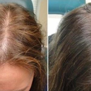 کوکتل میکرونیدلینگ ضد ریزش و تقویت کننده مو برندکلین بیوتی Klin Beauty