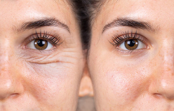 کوکتل مزونیدلینگ ترمیم کننده چروک و روشن کننده دور چشم برند (“Klin Beauty”)