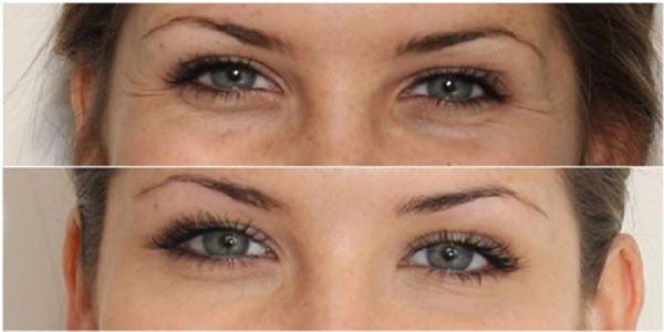کوکتل مزونیدلینگ ترمیم کننده چروک و روشن کننده دور چشم برند (“Klin Beauty”)