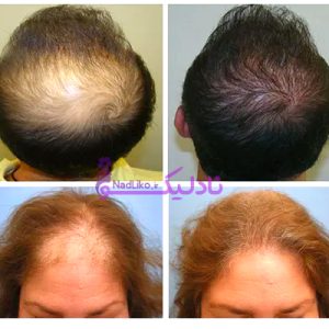 کوکتل مزوتراپی مو برند رویتاکر ساخت فرانسه تضمینی وارداتی اصلی