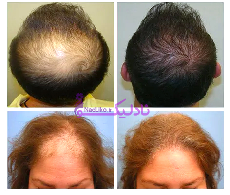 کوکتل مزوتراپی مو برند رویتاکر ساخت فرانسه تضمینی