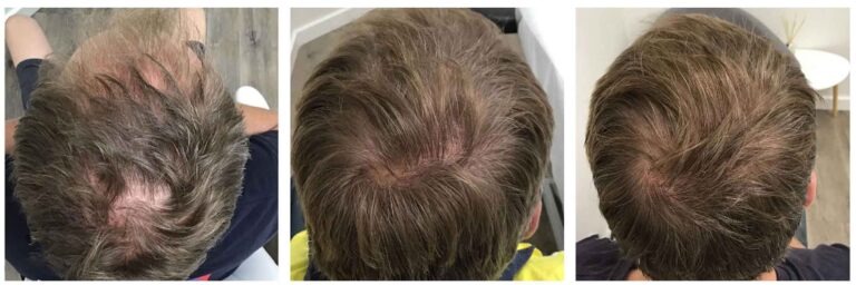 کوکتل درمان تاسی سر و ریزش موهای هورمونی و ژنتیکی فیوژن F-HAIR MEN